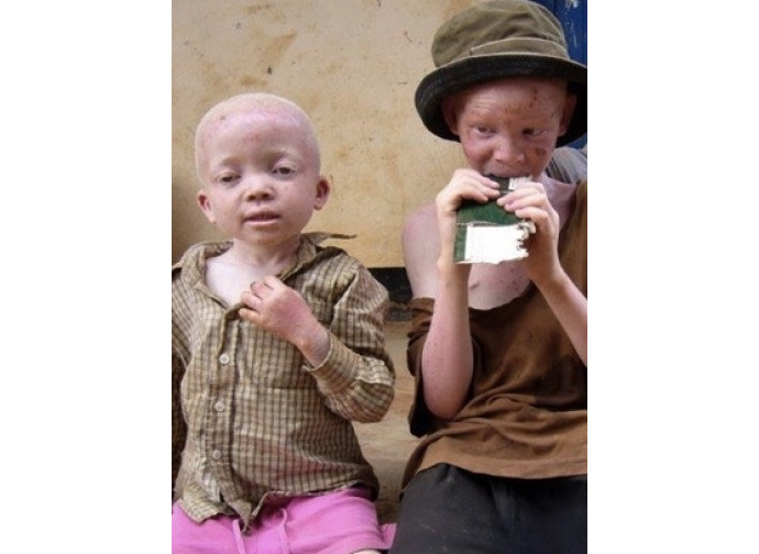 Bimbi albini africani
