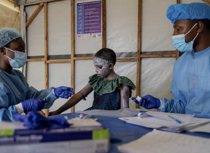 Prime cure per la "mpox" (La Presse)